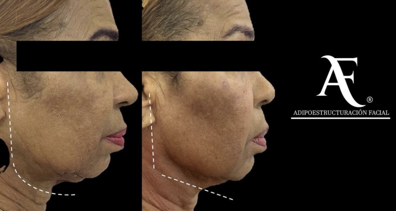 Adipoestructuración Facial