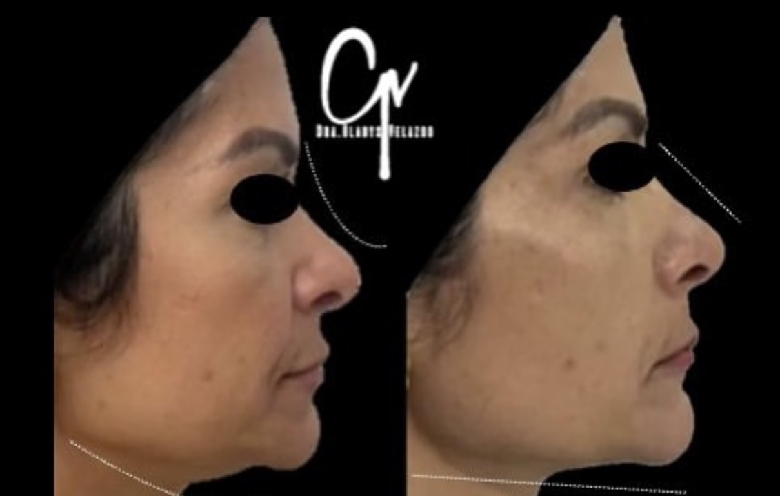 Adipoestructuración Facial