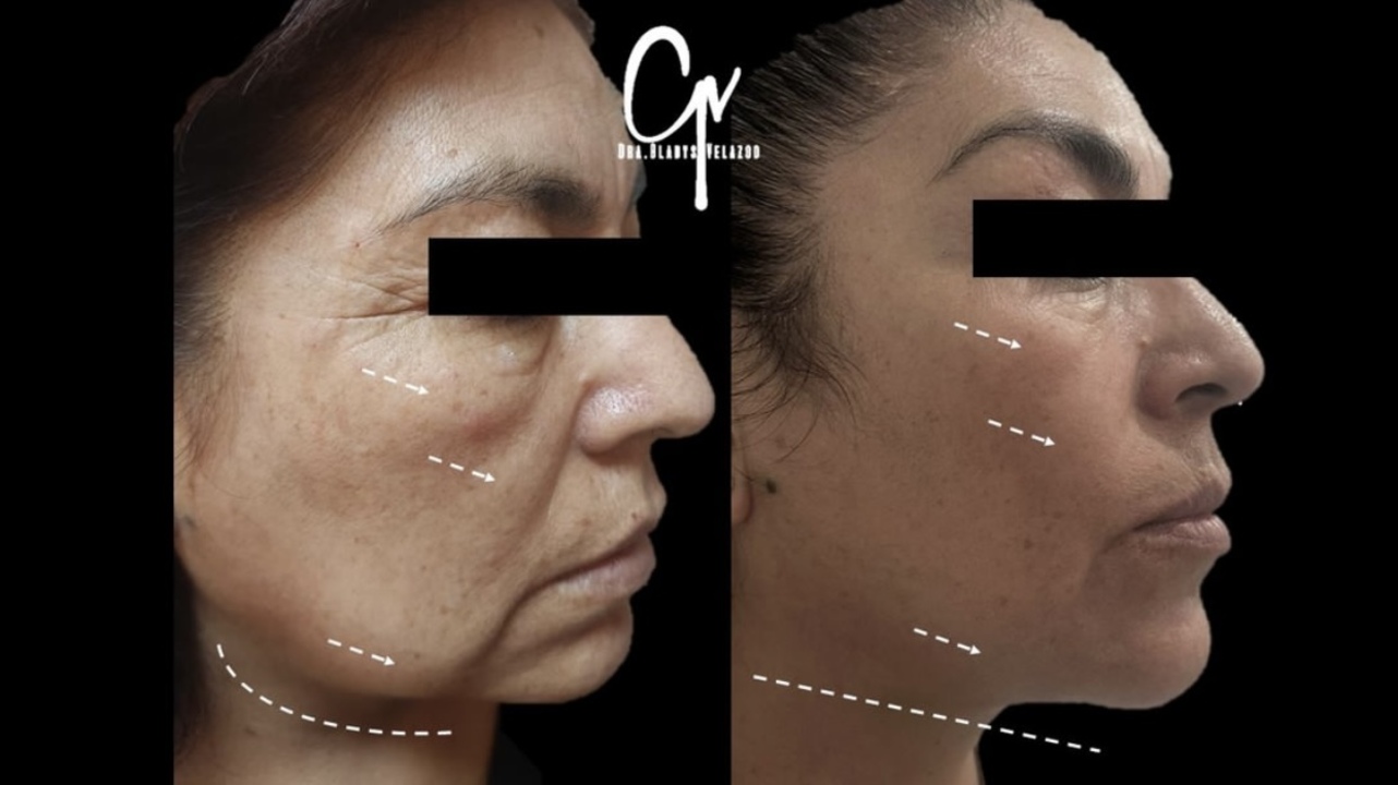 Adipoestructuración Facial