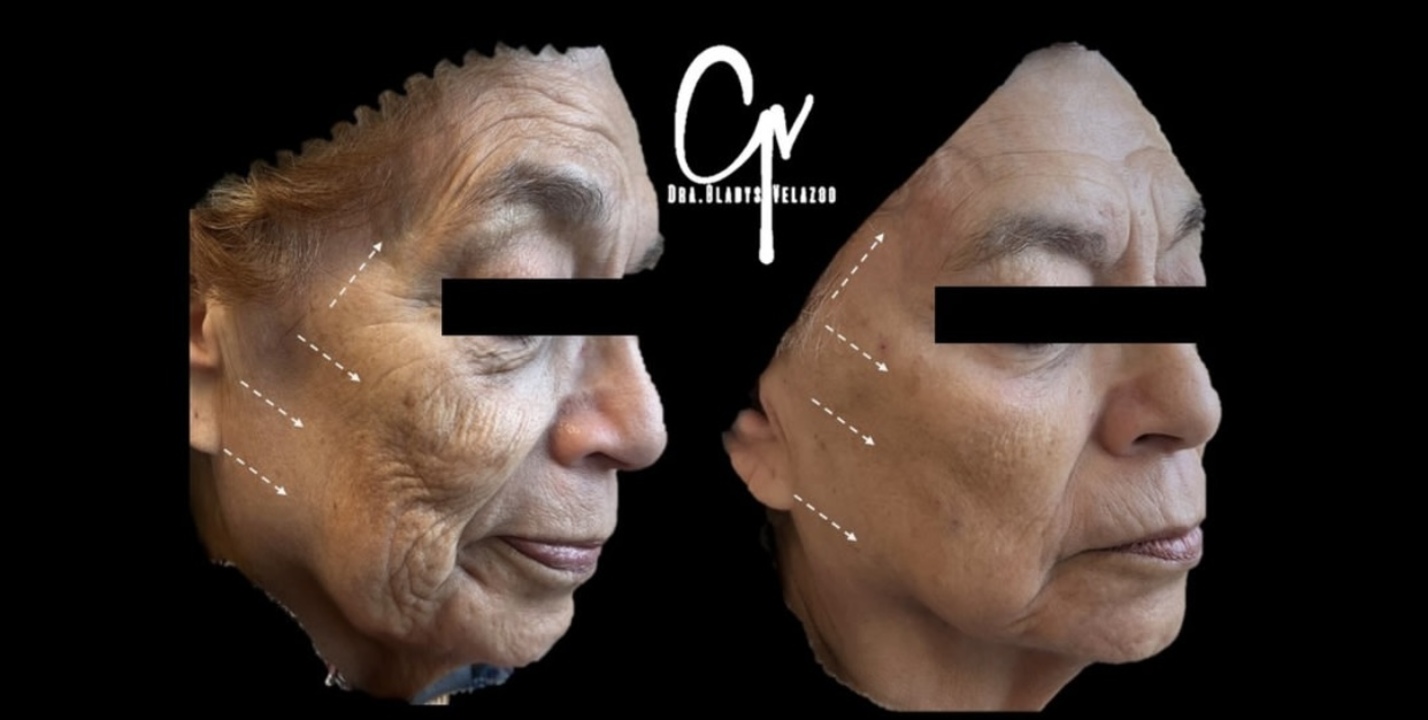 Adipoestructuración Facial